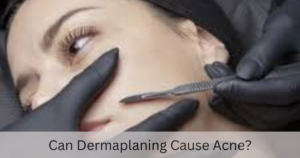 Can Dermaplaning Cause Acne?