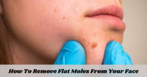 How To Remove Flat Moles From Your Face