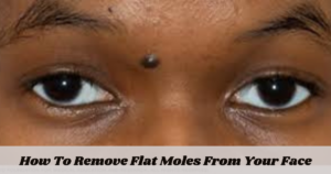 How To Remove Flat Moles From Your Face