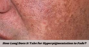 How Long Does It Take for Hyperpigmentation to Fade?