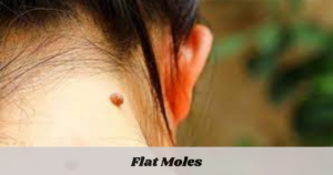 Flat Moles